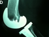 protesis-de-rodilla2