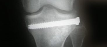Fractura de plato tibial reducida bajo control artroscópico