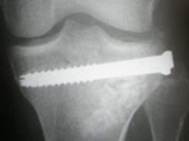 Fractura de plato tibial reducida bajo control artroscópico
