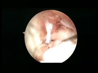 ligamento cruzado anterior roto