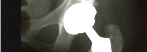 Prótesis de cadera