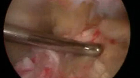 Ruptura parcial de ligamento cruzado anterior